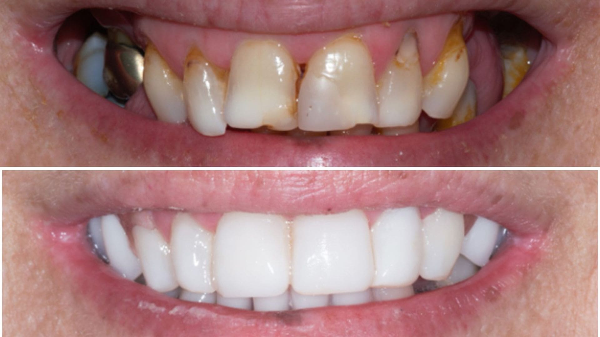 veneers vs composite bonding