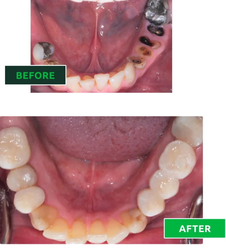 composite bonding