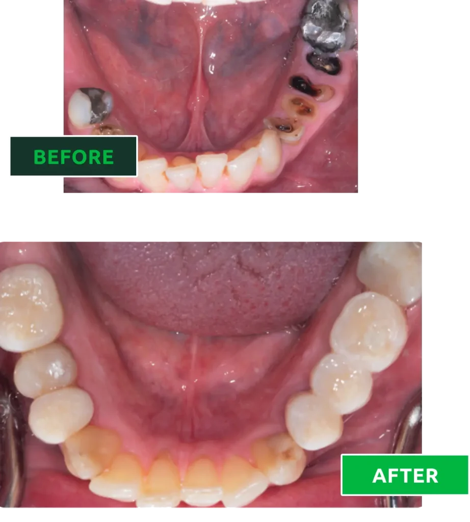 composite bonding