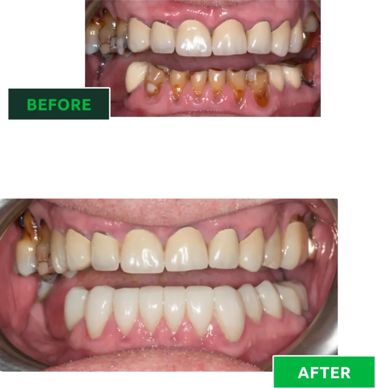 teeth makeover