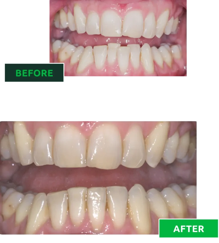 teeth straigthening