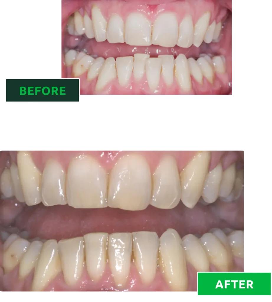 teeth straigthening