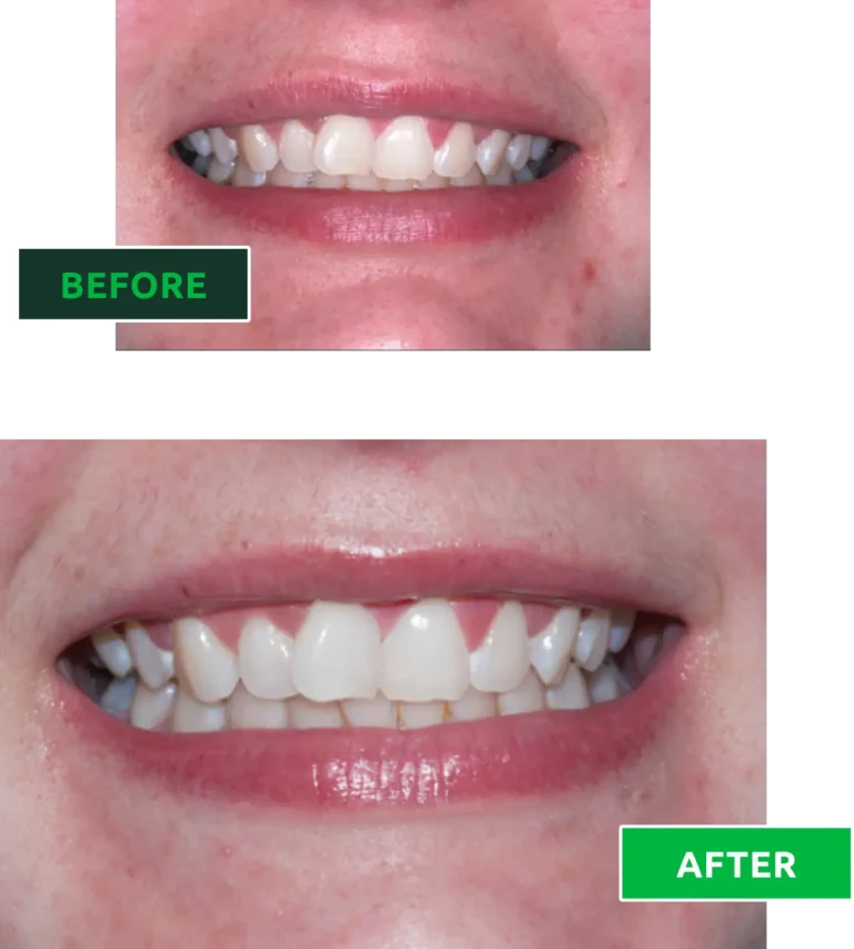 whitening before and after