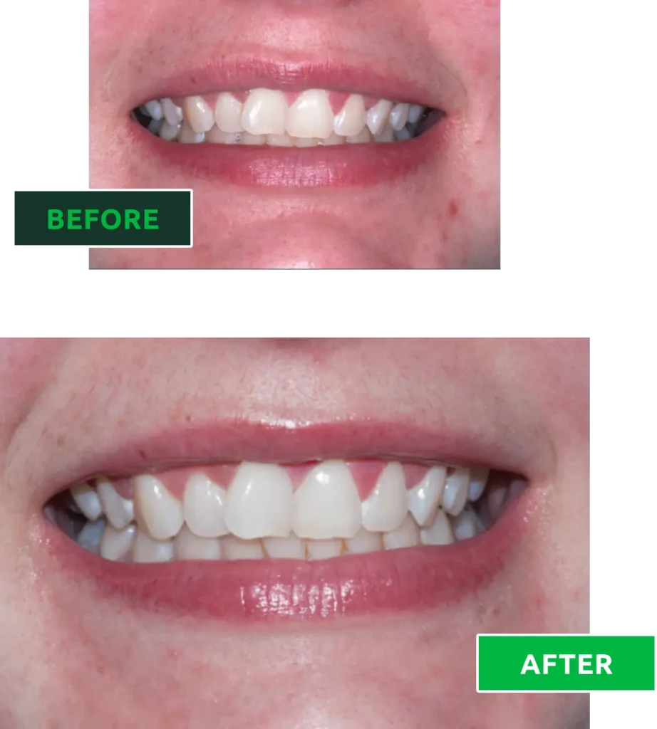 whitening before and after